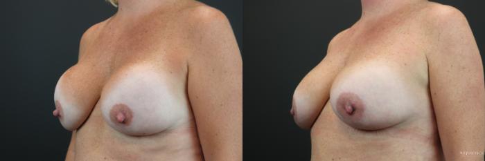 Before & After Implant Exchange Case 231 Left Oblique View in Glen Carbon, IL