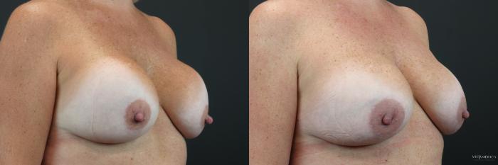Before & After Implant Exchange Case 231 Right Oblique View in Glen Carbon, IL