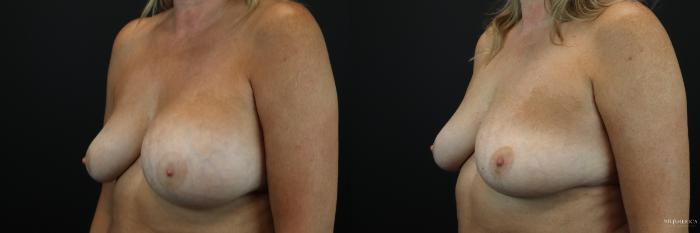 Before & After Implant Exchange Case 235 Left Oblique View in St. Louis, MO