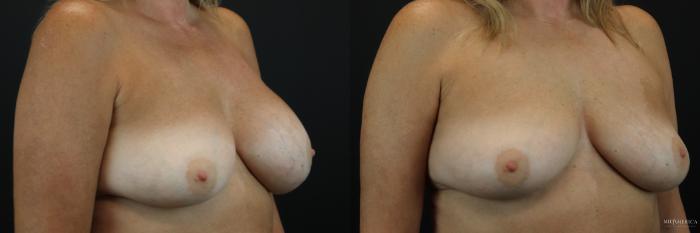 Before & After Implant Exchange Case 235 Right Oblique View in St. Louis, MO