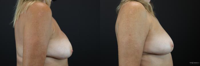 Before & After Implant Exchange Case 235 Right Side View in St. Louis, MO