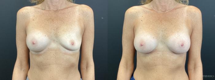 Before & After Implant Exchange Case 374 Front View in St. Louis, MO
