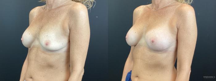 Before & After Implant Exchange Case 374 Left Oblique View in St. Louis, MO