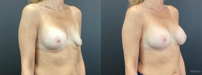 Before & After Implant Exchange Case 374 Right Oblique View in St. Louis, MO