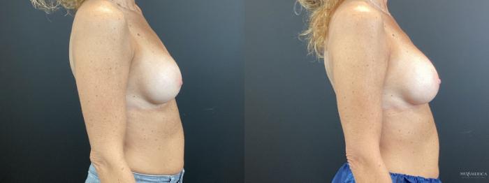 Before & After Implant Exchange Case 374 Right Side View in St. Louis, MO