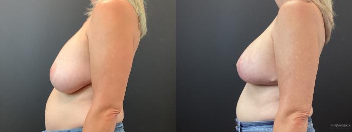 Before & After Implant Exchange Case 382 Left Side View in St. Louis, MO