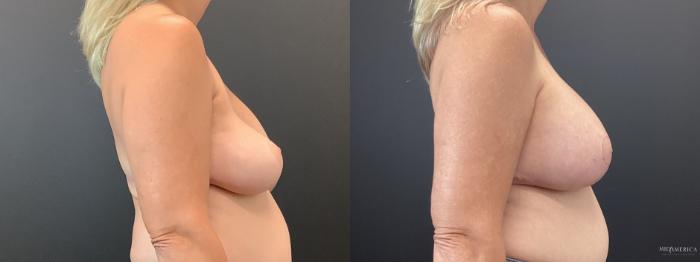 Before & After Implant Exchange Case 382 Right Side View in St. Louis, MO