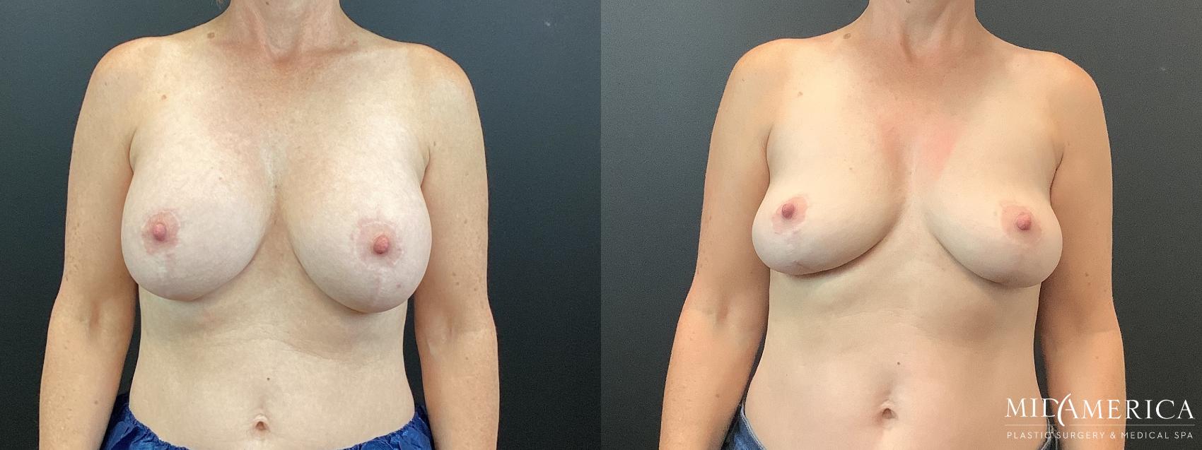 Before & After Implant Removal Case 353 Front View in St. Louis, MO