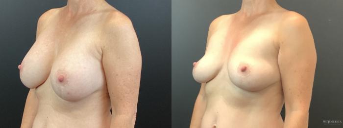 Before & After Implant Removal Case 353 Left Oblique View in St. Louis, MO