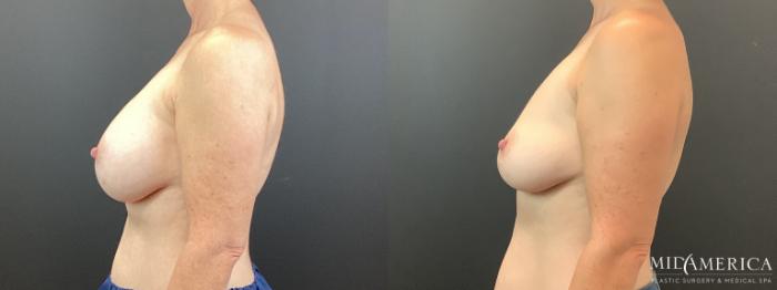 Before & After Implant Removal Case 353 Left Side View in St. Louis, MO