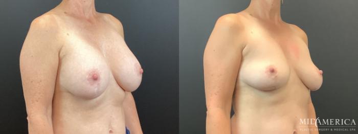 Before & After Implant Removal Case 353 Right Oblique View in St. Louis, MO