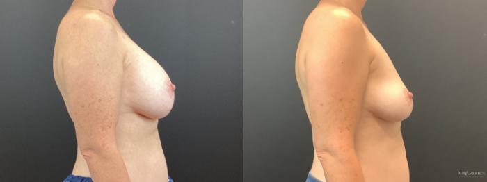 Before & After Implant Removal Case 353 Right Side View in St. Louis, MO