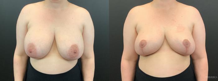 Before & After Implant Removal Case 364 Front View in St. Louis, MO