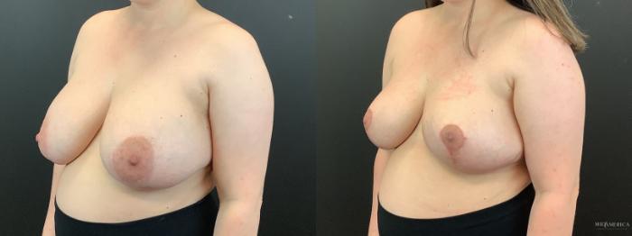 Before & After Implant Removal Case 364 Left Oblique View in St. Louis, MO