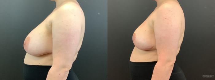 Before & After Implant Removal Case 364 Left Side View in St. Louis, MO