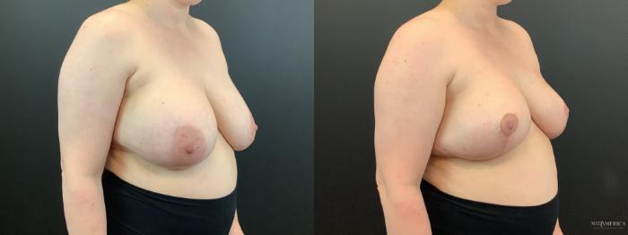 Before & After Implant Removal Case 364 Right Oblique View in St. Louis, MO