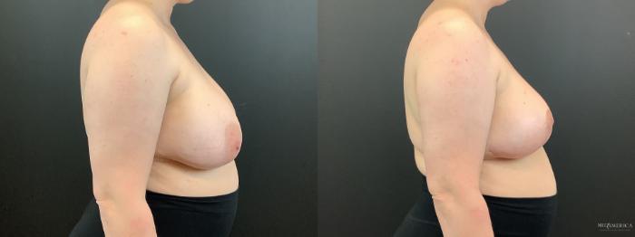 Before & After Implant Removal Case 364 Right Side View in St. Louis, MO