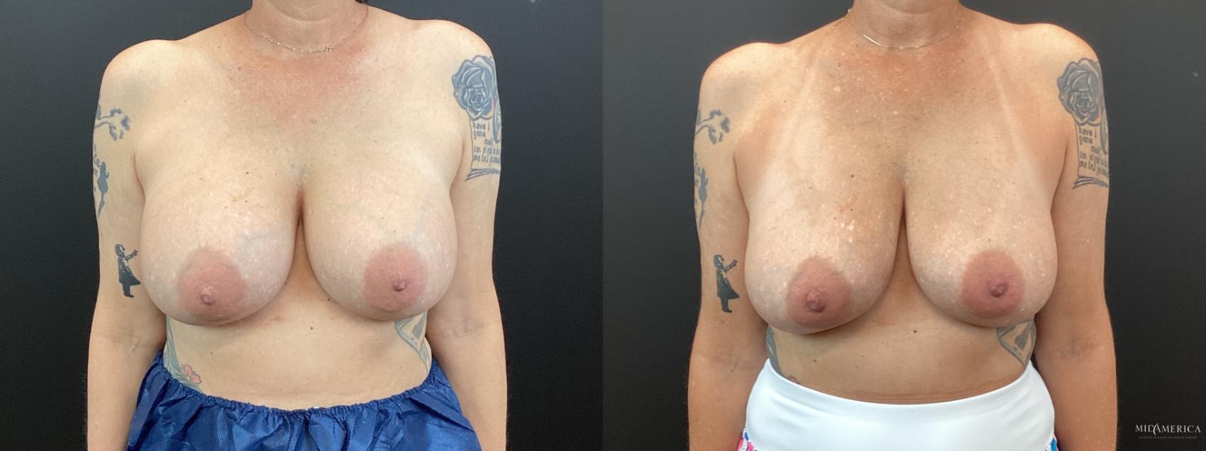 Before & After Implant Removal Case 365 Front View in St. Louis, MO