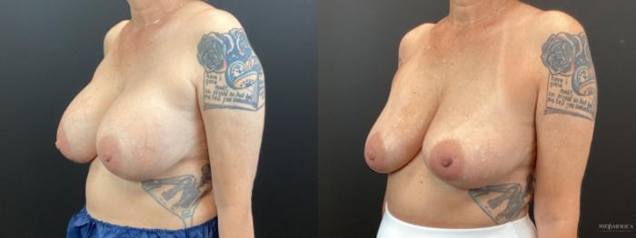 Before & After Implant Removal Case 365 Left Oblique View in St. Louis, MO
