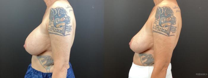 Before & After Implant Removal Case 365 Left Side View in St. Louis, MO