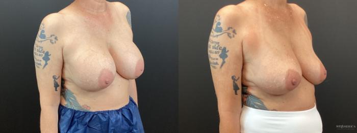 Before & After Implant Removal Case 365 Right Oblique View in St. Louis, MO