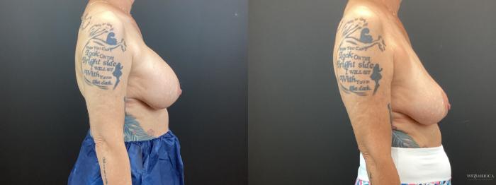 Before & After Implant Removal Case 365 Right Side View in St. Louis, MO