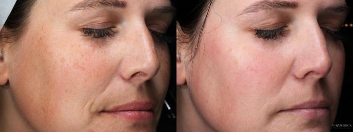 Before & After Laser Services  Case 390 Left Oblique View in St. Louis, MO