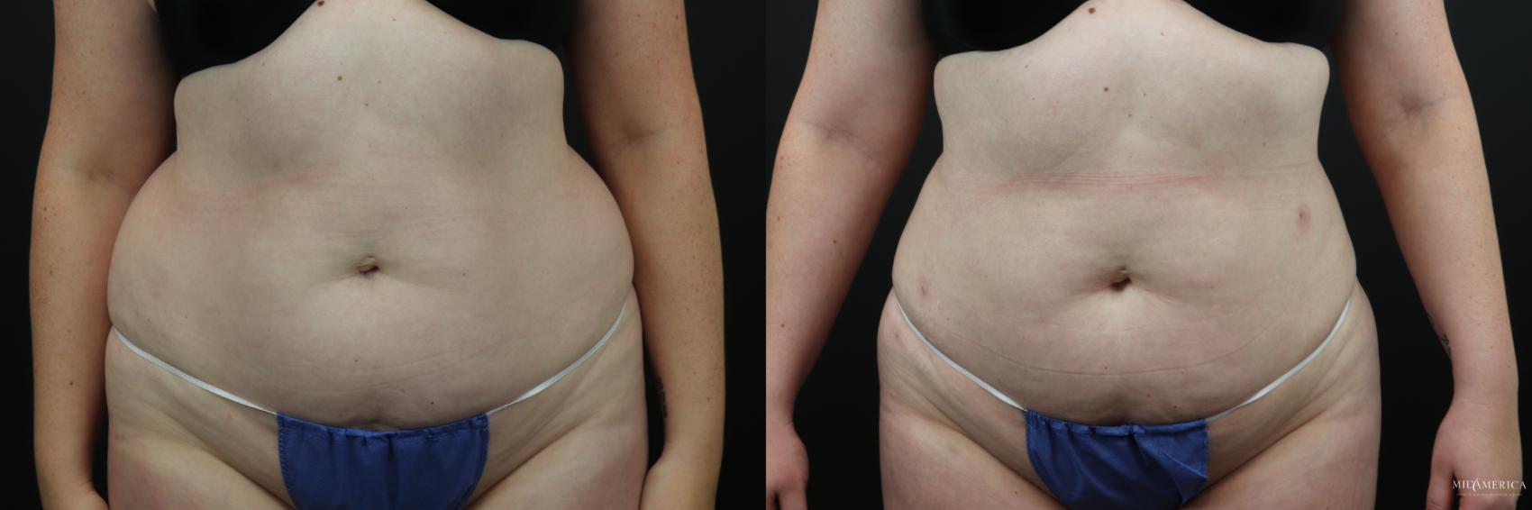 Before & After Liposuction Case 197 Front View in Glen Carbon, IL