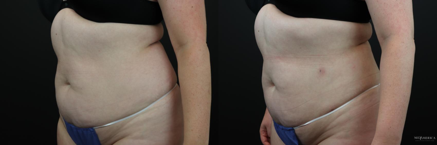 Before & After Liposuction Case 197 Left Oblique View in Glen Carbon, IL