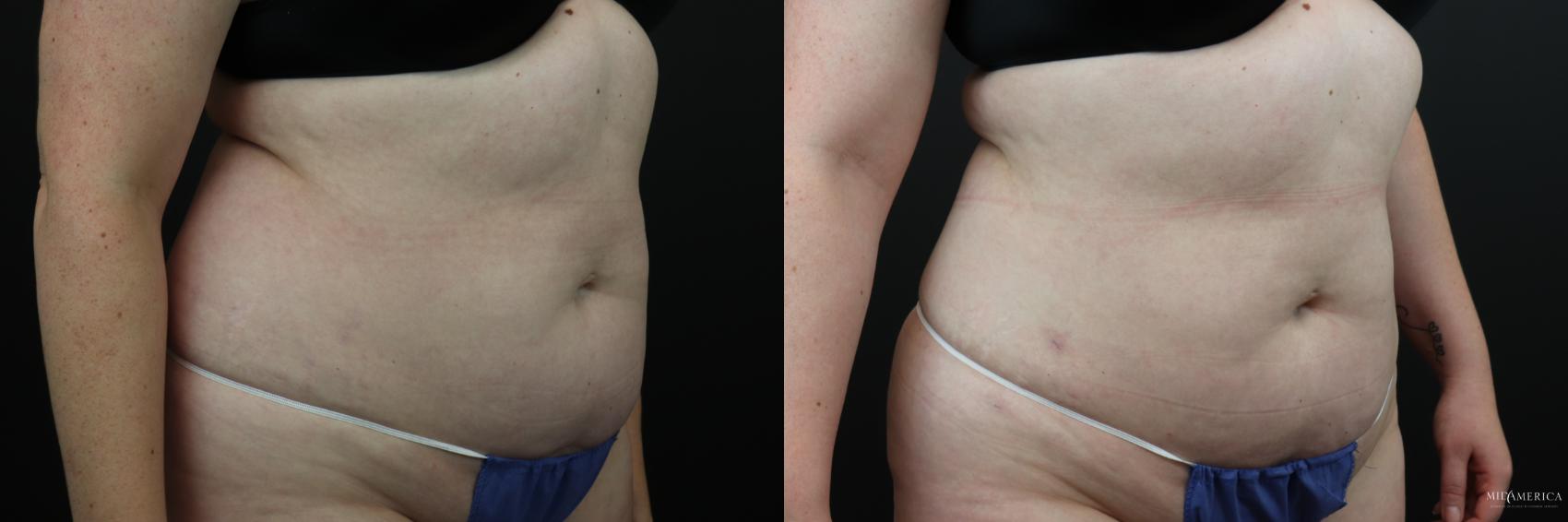 Before & After Liposuction Case 197 Right Oblique View in Glen Carbon, IL