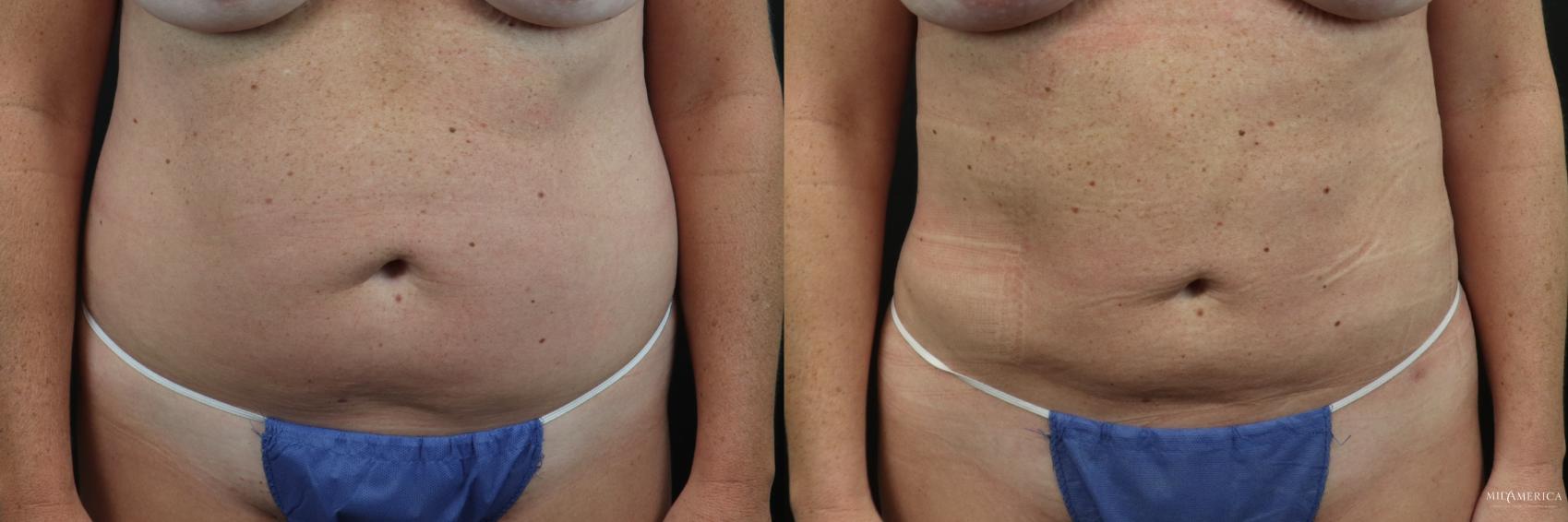 Before & After Liposuction Case 230 Front View in Glen Carbon, IL