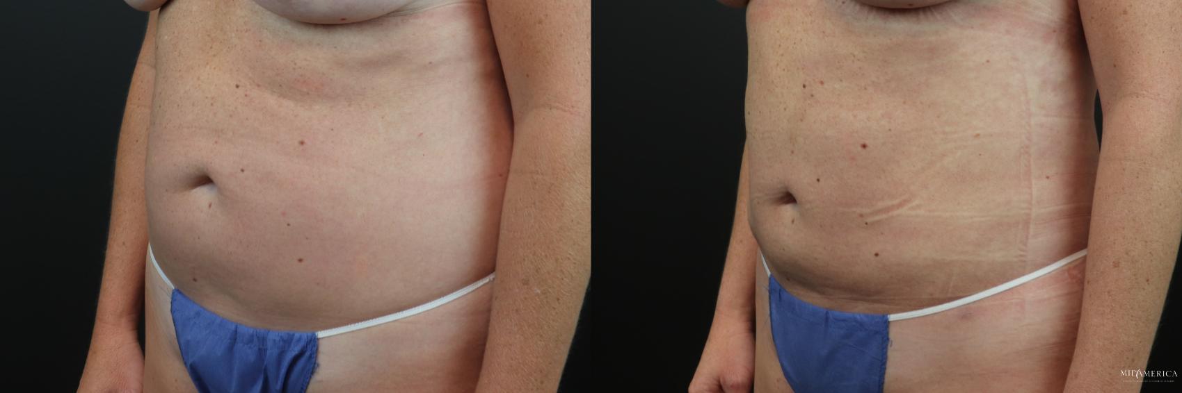 Before & After Liposuction Case 230 Left Oblique View in Glen Carbon, IL