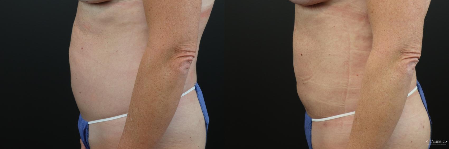 Before & After Liposuction Case 230 Left Side View in Glen Carbon, IL