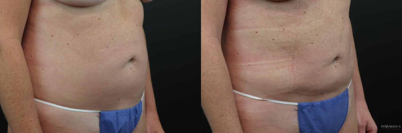 Before & After Liposuction Case 230 Right Oblique View in Glen Carbon, IL