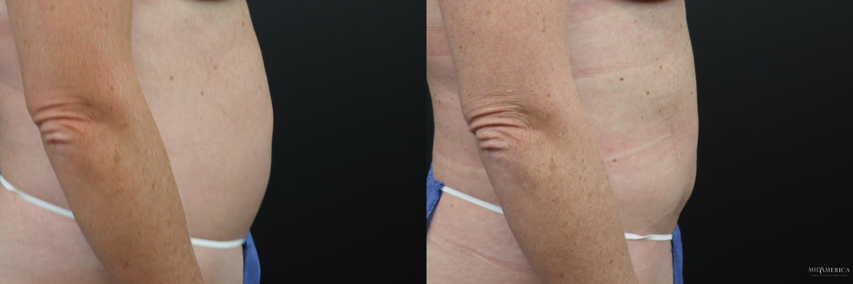 Before & After Liposuction Case 230 Right Side View in Glen Carbon, IL