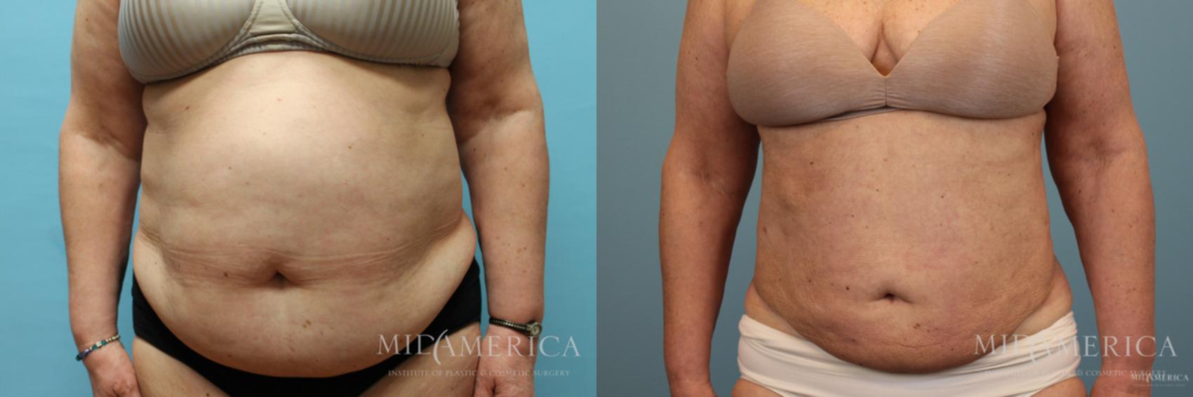 Before & After Liposuction Case 41 View #1 View in Glen Carbon, IL