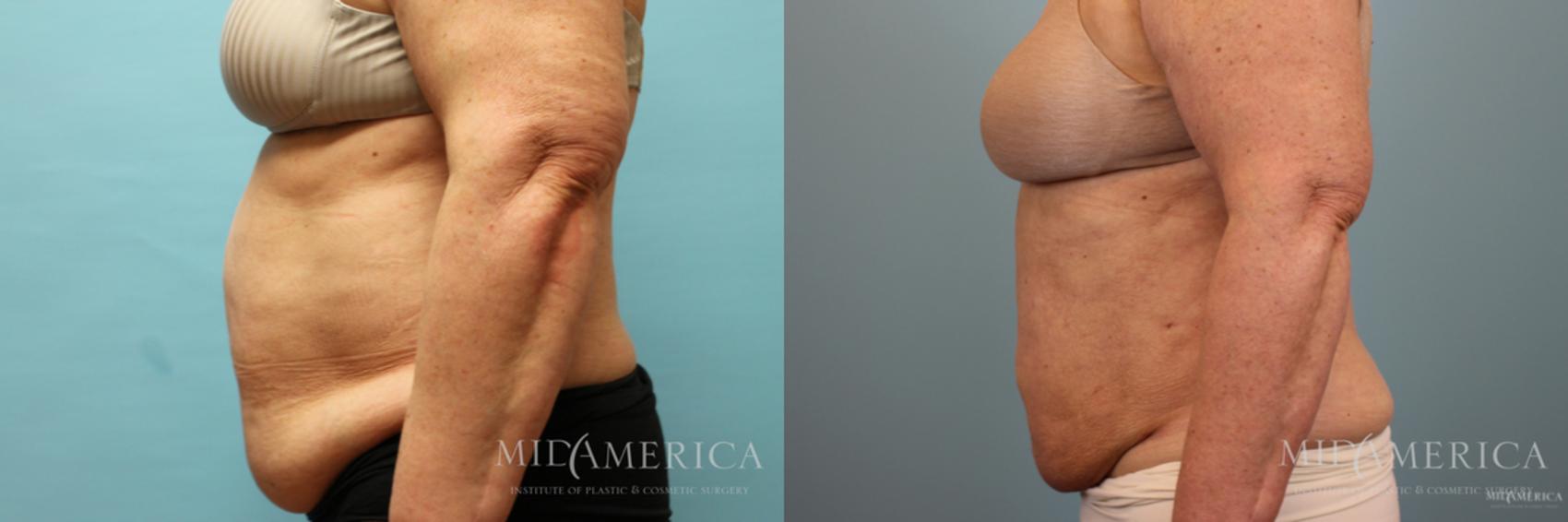 Before & After Liposuction Case 41 View #3 View in Glen Carbon, IL