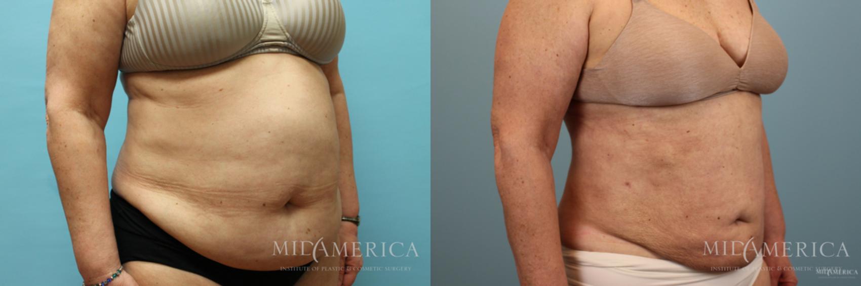 Before & After Liposuction Case 41 View #4 View in Glen Carbon, IL