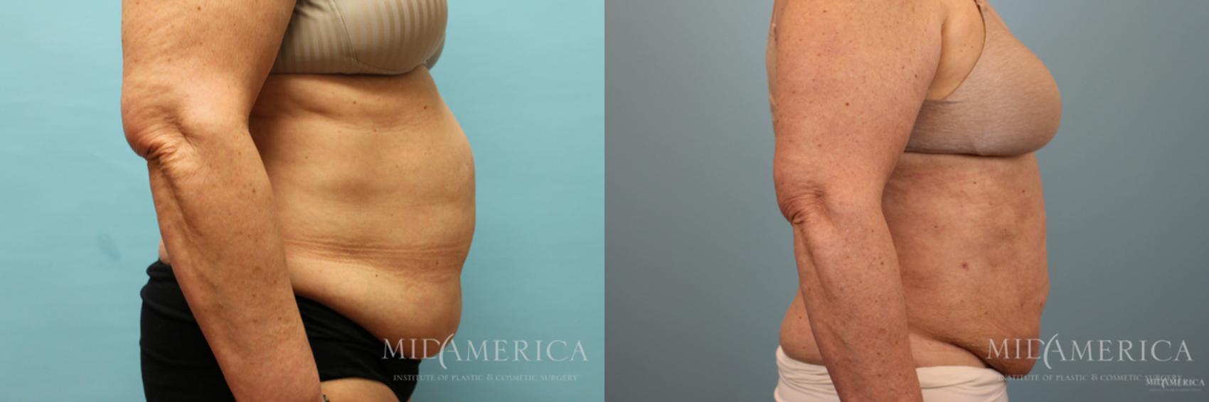 Before & After Liposuction Case 41 View #5 View in Glen Carbon, IL