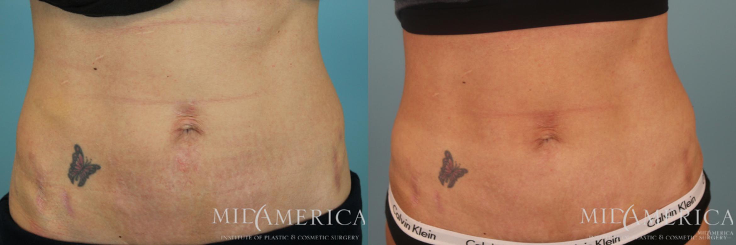 Before & After Microneedling Case 56 View #1 View in Glen Carbon, IL