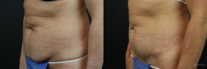 Before & After Mini Tummy Tuck Case 224 Left Oblique View in St. Louis, MO