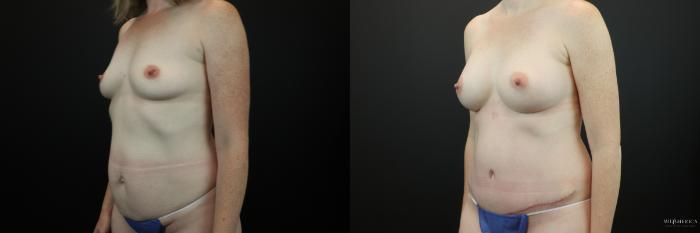 Before & After Mommy Makeover Case 212 Left Oblique View in Glen Carbon, IL