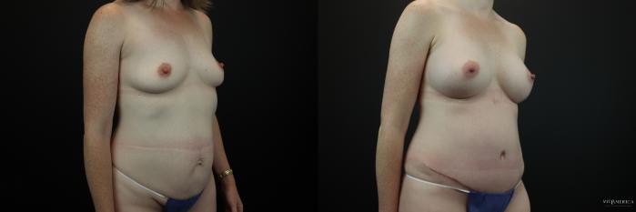 Before & After Mommy Makeover Case 212 Right Oblique View in Glen Carbon, IL