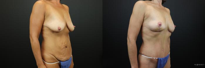 Before & After Mommy Makeover Case 221 Right Oblique View in St. Louis, MO