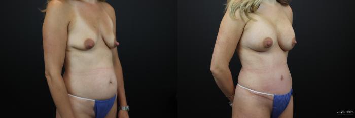 Before & After Mommy Makeover Case 237 Right Oblique View in St. Louis, MO