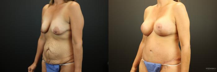 Before & After Mommy Makeover Case 254 Left Oblique View in St. Louis, MO
