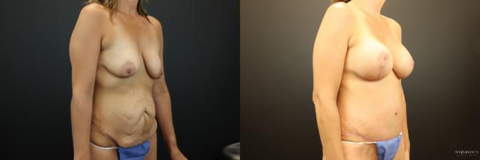 Before & After Mommy Makeover Case 254 Right Oblique View in St. Louis, MO