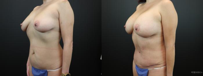 Before & After Mommy Makeover Case 267 Left Oblique View in St. Louis, MO