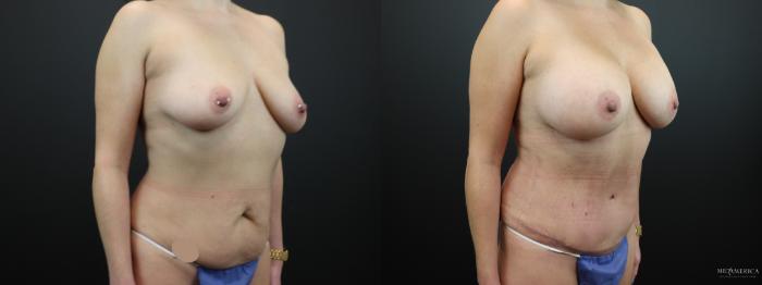 Before & After Mommy Makeover Case 267 Right Oblique View in St. Louis, MO