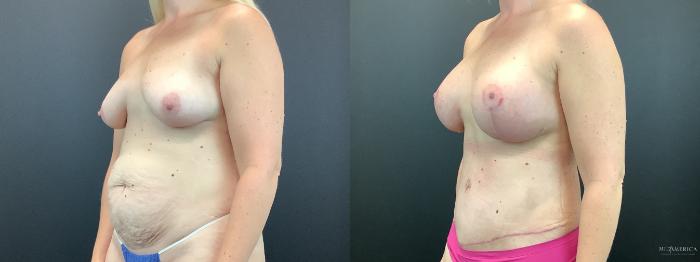 Before & After Mommy Makeover Case 271 Left Oblique View in St. Louis, MO